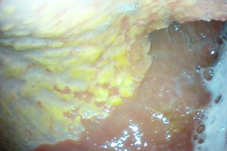 Internal image of gastric ulcer