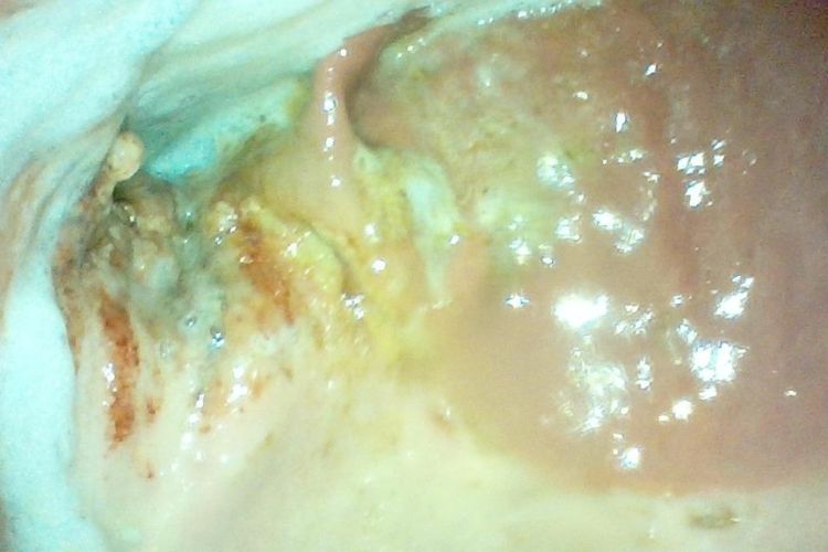 Internal image of gastric ulcer